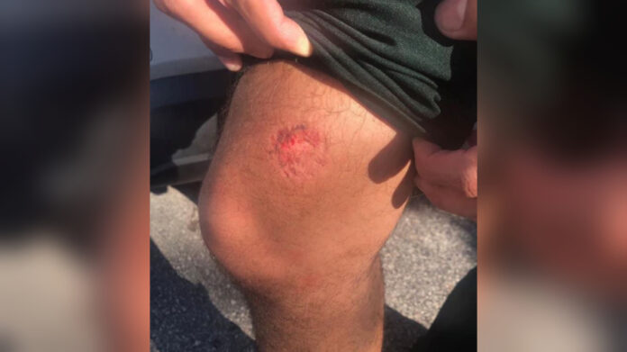 suspect-bites-through-florida-deputy’s-pants-during-arrest